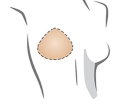 MaxTara Silicone Breast Forms Mastectomy Fake Boobs B Cup 300g